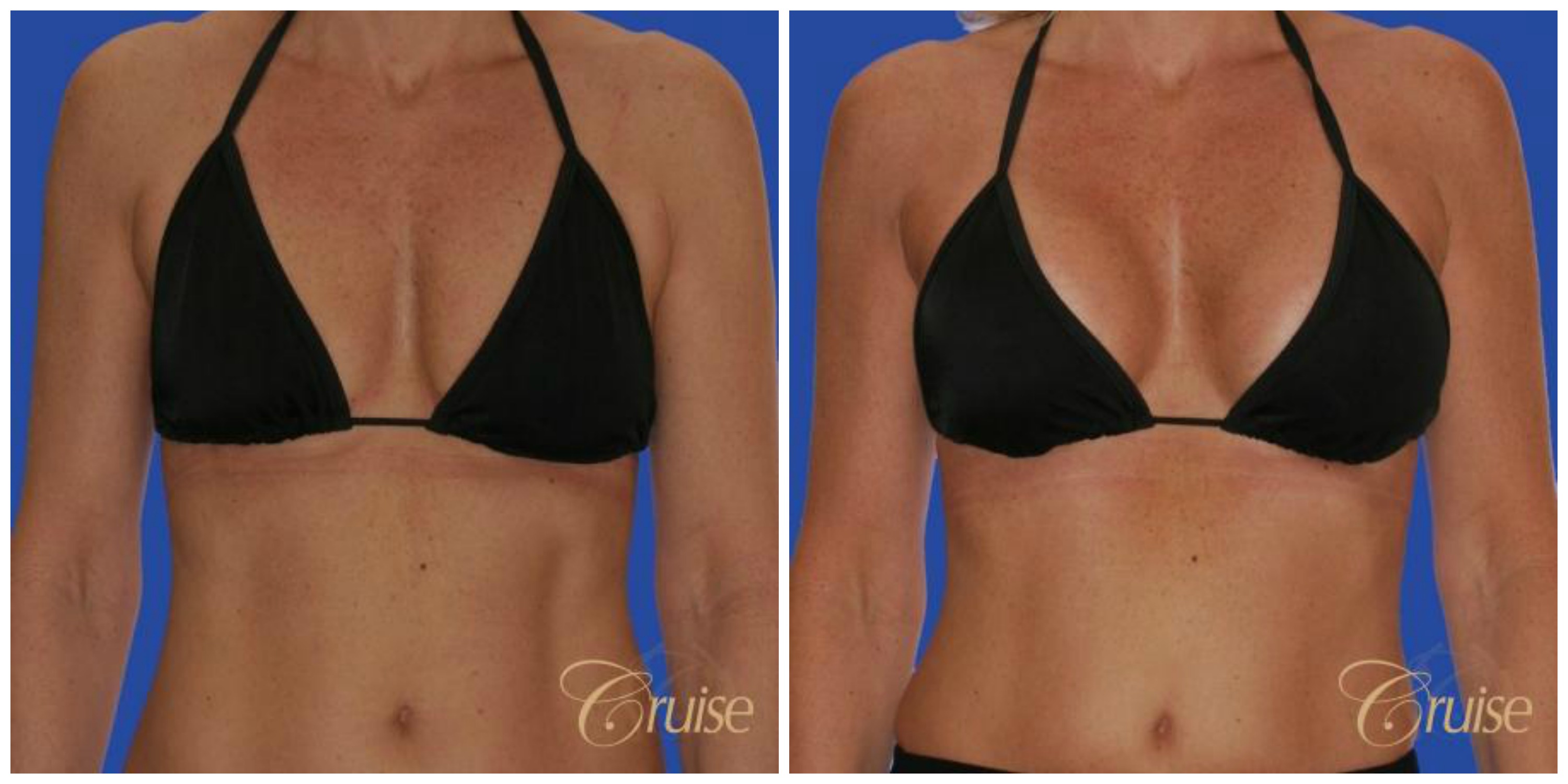 Breast Reduction And Lift With Implants